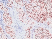 NKX2.1 Antibody / Lung Epithelial Cell Marker Antibody Lung Carcinoma IHC. Immunohistochemistry analysis of human lung carcinoma tissue. FFPE human lung carcinoma sections demonstrate strong HRP-DAB brown nuclear staining in tumor epithelial cells, consistent with expression of the NKX2.1 lung epithelial lineage transcription factor. Positive tumor cell nuclei are distributed throughout the carcinoma cell population, reflecting the role of NKX2.1 as a marker of pulmonary epithelial differentiation and respiratory epithelial lineage identity. Surrounding stromal elements and non-epithelial cells show minimal staining. Nuclear hematoxylin counterstain is visible in blue, highlighting the nuclear localization pattern expected for this lung epithelial transcription factor marker.