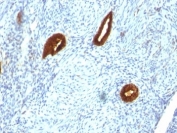 IHC analysis of formalin-fixed, paraffin-embedded human endometrial carcinoma stained with anti-CK19 antibody (clone SPM266).