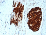 INHA Antibody Rabbit Monoclonal (clone INHA/6598R) IHC staining of human testicular carcinoma. Immunohistochemistry analysis of FFPE human testicular carcinoma tissue using INHA Antibody Rabbit Monoclonal (clone INHA/6598R) at 2 ug/ml in PBS for 30 minutes at room temperature shows strong HRP-DAB brown cytoplasmic staining in tumor cells, consistent with Inhibin subunit alpha (INHA) expression in sex cord or steroidogenic tumor cell populations, while surrounding stromal elements remain largely negative. HIER: tissue sections were boiled in pH 9 10mM Tris with 1mM EDTA for 20 minutes and allowed to cool before testing.