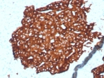 Synaptophysin Antibody Microarray Specificity Validated Clone SYP/4389R. Immunohistochemistry analysis of FFPE human pancreatic tissue using Synaptophysin Antibody Microarray Specificity Validated Clone SYP/4389R. The monoclonal antibody clone SYP/4389R produces strong cytoplasmic staining in pancreatic islet cells consistent with Synaptophysin / SYP expression in neuroendocrine cells. Synaptophysin is a synaptic vesicle membrane glycoprotein widely used as a marker of neuroendocrine differentiation, and the observed granular cytoplasmic staining pattern aligns with the known localization of SYP within synaptic vesicles. Microarray specificity validation of clone SYP/4389R supports selective target recognition, helping confirm specific detection of Synaptophysin protein in immunohistochemistry analysis of formalin-fixed paraffin-embedded pancreatic tissue.