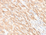 ALB Antibody Liver Carcinoma IHC. Immunohistochemistry staining of FFPE human liver carcinoma in colon tissue with ALB antibody (clone ALB/6411R). HIER: boil tissue sections in pH 9 10mM Tris with 1mM EDTA for 20 min and allow to cool before testing.