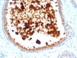 MGB1 Antibody clone MGB/4811R immunohistochemistry of human lactating breast tissue. FFPE human lactating breast tissue was stained with MGB1 antibody (clone MGB/4811R). HRP-DAB brown chromogenic signal highlights strong cytoplasmic staining in secretory epithelial cells lining mammary glandular structures and luminal secretions, consistent with high expression of Mammaglobin A / SCGB2A2 in lactating breast epithelium, while surrounding stromal cells show minimal staining. Heat-induced epitope retrieval was performed by boiling tissue sections in pH 9 10mM Tris with 1mM EDTA for 20 minutes followed by cooling prior to staining.