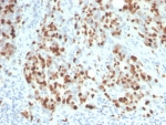 Recombinant Ki67 Antibody Mouse Monoclonal rMKI67/6615 / MKI67 Antibody. Immunohistochemistry analysis of FFPE human lymph node tissue using recombinant Ki67 antibody mouse monoclonal rMKI67/6615. Strong nuclear brown staining is observed in numerous proliferating lymphoid cells within germinal center regions, consistent with the known expression pattern of Ki-67 / MKI67 in actively dividing cells. Surrounding lymphocytes with lower proliferative activity show reduced staining. Heat-induced epitope retrieval was performed by boiling tissue sections in pH 9 10mM Tris with 1mM EDTA for 20 minutes followed by cooling prior to staining.