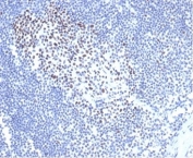 MSH2 Antibody Recombinant Mouse MAb rMSH2/6548. Immunohistochemistry of FFPE cat lymph node tissue demonstrates nuclear staining in a subset of lymphoid cells, consistent with the nuclear localization of MutS homolog 2 (MSH2), a DNA mismatch repair protein involved in maintaining genomic stability. Brown chromogenic signal highlights MSH2-positive nuclei among lymphoid populations within the lymph node architecture, while surrounding cells show variable staining intensity. Heat-induced epitope retrieval was performed by boiling tissue sections in pH 9 10mM Tris with 1mM EDTA for 20 minutes followed by cooling prior to antibody incubation.