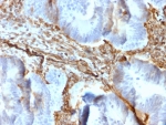 VIM Antibody / Cytoskeletal Stability Marker Antibody Colon IHC. Immunohistochemistry analysis of FFPE human colon tissue using Vimentin antibody shows strong HRP-DAB brown cytoplasmic staining in stromal and pericryptal mesenchymal cells surrounding colonic glands, with minimal staining in epithelial cells. The recombinant rabbit monoclonal clone rVIM/6431 highlights continuous, well-defined filamentous networks within the cytoplasm, consistent with stable intermediate filament structures. The uniform intensity and organized distribution of Vimentin-positive filaments support its role in maintaining cytoskeletal stability and structural integrity within stromal compartments.