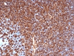 VIM Antibody Tonsil IHC. Immunohistochemistry staining of FFPE human tonsil tissue with recombinant VIM antibody (clone rVIM/6431). HIER: boil tissue sections in pH 9 10mM Tris with 1mM EDTA for 20 min and allow to cool before testing.