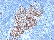 TOP2A Antibody / DNA Topoisomerase II Alpha Antibody (clone rTOP2A/6569). Immunohistochemistry analysis of FFPE human lymph node tissue demonstrates nuclear staining corresponding to expression of DNA Topoisomerase II alpha in proliferating lymphoid cells. Nuclear immunoreactivity is concentrated within germinal center lymphocytes, consistent with the known role of DNA Topoisomerase II alpha as a chromosome replication enzyme expressed during active cell division. The DNA Topoisomerase II Alpha Antibody highlights proliferating lymphoid populations within germinal centers, while surrounding resting lymphocytes show minimal staining. Antigen retrieval was performed by boiling tissue sections in pH 9 Tris-EDTA buffer prior to immunohistochemistry staining.