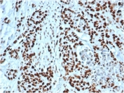 MSH2 Antibody Recombinant Rabbit MAb MSH2/6549R. Immunohistochemistry of FFPE human colon tissue demonstrates strong nuclear staining in epithelial cells, consistent with the nuclear localization of MutS homolog 2 (MSH2), a key DNA mismatch repair protein. Brown chromogenic signal highlights MSH2-positive nuclei throughout the colonic epithelium, while surrounding stromal cells show weaker or variable staining. Heat-induced epitope retrieval was performed by boiling tissue sections in pH 9 10mM Tris with 1mM EDTA for 20 minutes followed by cooling prior to antibody incubation.