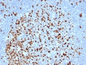 Topoisomerase II alpha Antibody / Mitotic Chromosome Enzyme Antibody (clone TOP2A/6570R). Immunohistochemistry analysis of FFPE human lymph node tissue demonstrates strong nuclear staining of DNA Topoisomerase II alpha in proliferating lymphoid cells. Nuclear immunoreactivity is enriched within germinal center lymphocytes, reflecting the high mitotic activity of these cells where mitotic chromosome condensation and structural organization are actively occurring. As a Mitotic Chromosome Enzyme Antibody, clone TOP2A/6570R highlights cells undergoing mitosis in which DNA Topoisomerase II alpha supports chromosome condensation and mitotic chromosome architecture required for accurate cell division. HIER: boil tissue sections in pH 9 Tris-EDTA buffer for 20 min followed by cooling at RT prior to immunohistochemistry staining.