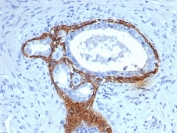 IHC staining of FFPE human prostate tissue with CK14 antibody (clone KRT14/4133). HIER: boil tissue sections in pH 9 10mM Tris with 1mM EDTA for 20 min and allow to cool before testing.