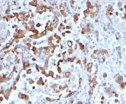Keratin 20 Antibody Recombinant Rabbit MAb KRT20/4879R. Immunohistochemistry analysis of FFPE human colon tissue using recombinant rabbit monoclonal Keratin 20 antibody (clone KRT20/4879R) at 2 ug/ml. HRP-DAB brown chromogenic staining highlights cytoplasmic Keratin 20 / Cytokeratin 20 (KRT20) expression in epithelial cells lining colonic glandular structures, while surrounding stromal cells remain largely negative. The staining pattern reflects the expected epithelial localization of this intermediate filament protein in gastrointestinal mucosa. HIER: boil tissue sections in pH 9 10 mM Tris with 1 mM EDTA for 20 min and allow to cool before testing.