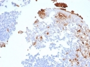 Myeloperoxidase (MPO) Antibody Human Tonsil IHC. Immunohistochemistry staining of FFPE human tonsil tissue using Myeloperoxidase Antibody / Neutrophil Marker Antibody (clone rMPO/6904) demonstrates distinct granular cytoplasmic HRP-DAB brown staining within scattered myeloid and granulocytic cells localized predominantly within interfollicular and stromal regions. The staining pattern is consistent with expression of Myeloperoxidase (MPO), a heme-containing peroxidase enzyme characteristically expressed by neutrophils, granulocytes, and other cells of myeloid lineage. MPO-positive cells are readily distinguished from the surrounding lymphoid populations, which show little to no staining, highlighting the specificity of MPO as a marker of granulocytic differentiation and innate immune cell identification. HIER: boil tissue sections in pH 9 Tris-EDTA buffer (10 mM Tris, 1 mM EDTA) for 20 minutes and allow to cool before testing.