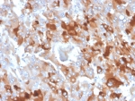 CLU Antibody Adrenal Gland IHC. Immunohistochemistry analysis of FFPE human adrenal gland tissue using CLU antibody. The mouse monoclonal antibody clone CLU/4727 demonstrates cytoplasmic staining in glandular cells, consistent with Clusterin / CLU expression as a cytoprotective stress response marker. Signal is observed within adrenal cortical cell populations, reflecting stress-associated upregulation of this secreted chaperone protein, while surrounding stromal elements show lower staining. HIER: boil tissue sections in 10 mM Tris with 1 mM EDTA, pH 9, for 20 min followed by cooling prior to staining.