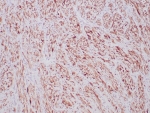 ALK Antibody Inflammatory Myofibroblastic Tumor IHC. Immunohistochemistry staining of FFPE human inflammatory myofibroblastic tumor tissue using recombinant rabbit monoclonal clone ALK1/6698R demonstrates diffuse cytoplasmic HRP-DAB brown staining in spindle-shaped neoplastic cells, consistent with ALK fusion protein-associated expression in inflammatory myofibroblastic tumor. The observed staining pattern supports the established role of ALK rearrangement-associated kinase activation in mesenchymal tumor signaling pathways. HIER: boil tissue sections in pH 9 10mM Tris with 1mM EDTA for 20 min and allow to cool before testing.