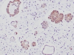 ALK Antibody Lung Adenocarcinoma IHC. Immunohistochemistry staining of FFPE human lung adenocarcinoma tissue using recombinant rabbit monoclonal clone ALK1/6698R demonstrates cytoplasmic HRP-DAB brown staining in malignant gland-forming epithelial cells, consistent with ALK fusion protein-associated expression in lung adenocarcinoma. The observed staining pattern aligns with the established role of ALK rearrangements in molecularly defined subsets of non-small cell lung carcinoma and oncogenic kinase signaling pathways. HIER: boil tissue sections in pH 9 10mM Tris with 1mM EDTA for 20 min and allow to cool before testing.