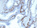 p63 Antibody Microarray Specificity Validated Clone TP63/4379R Prostate Cacner IHC. Immunohistochemistry analysis of Tumor protein 63 (TP63) in FFPE human prostate cancer tissue using a recombinant rabbit monoclonal p63 antibody for IHC (clone TP63/4379R) demonstrates strong HRP-DAB brown nuclear staining in basal epithelial cells, while malignant glandular epithelial cells show little to no staining. This distinct basal-restricted pattern supports the role of TP63 as a basal cell marker and highlights loss of basal cell layer in prostate carcinoma. The clean nuclear signal with minimal background is consistent with the high specificity profile established by microarray validation, supporting accurate interpretation of TP63 expression in tissue sections. Heat-induced epitope retrieval was performed by boiling tissue sections in pH 9 10mM Tris with 1mM EDTA for 20 minutes followed by cooling prior to antibody incubation.