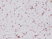 OLIG2 Antibody Oligodendroglioma IHC. Immunohistochemical analysis of Oligodendrocyte transcription factor 2 (OLIG2) in formalin-fixed, paraffin-embedded human oligodendroglioma tissue using OLIG2 antibody clone OLIG2/6695R. Strong nuclear staining is observed in tumor cells distributed throughout the tissue, consistent with oligodendrocyte lineage origin and the role of OLIG2 as a neural lineage transcription factor. The widespread nuclear signal highlights tumor cell populations and supports identification of glial-derived neoplastic cells. Required HIER: boil tissue sections in pH 9 10mM Tris with 1mM EDTA for 20 min and allow to cool before testing.