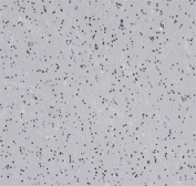 OLIG2 Antibody Glioma IHC. Immunohistochemical analysis of Oligodendrocyte transcription factor 2 (OLIG2) in formalin-fixed, paraffin-embedded human glioma tissue using OLIG2 antibody clone OLIG2/6695R. Diffuse nuclear staining is observed in tumor cells throughout the section, consistent with OLIG2 expression in glial-derived neoplastic cells and its role as an oligodendrocyte lineage transcription factor. The widespread nuclear signal supports identification of neural lineage tumor populations. Required HIER: boil tissue sections in pH 9 10mM Tris with 1mM EDTA for 20 min and allow to cool before testing.