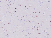 OLIG2 Antibody Cerebrum IHC. Immunohistochemical analysis of Oligodendrocyte transcription factor 2 (OLIG2) in formalin-fixed, paraffin-embedded human cerebrum tissue using OLIG2 antibody clone OLIG2/6695R. Scattered nuclear staining is observed in glial cells throughout the cerebral parenchyma, consistent with OLIG2 expression in oligodendrocyte lineage cells. The distribution of positive nuclei reflects normal glial cell populations within brain tissue. Required HIER: boil tissue sections in pH 9 10mM Tris with 1mM EDTA for 20 min and allow to cool before testing.