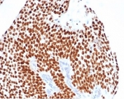 GATA3 Antibody Bladder Carcinoma IHC. Immunohistochemistry staining of FFPE human bladder carcinoma tissue with GATA-3 antibody (clone GATA3/4550R). HIER: boil tissue sections in pH 9 10mM Tris with 1mM EDTA for 20 min and allow to cool before testing.