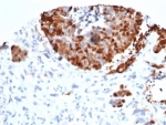 Recombinant INSM1 Antibody (clone INSM1/6286R). Immunohistochemistry of Insulinoma-associated protein 1 (INSM1) in formalin-fixed, paraffin-embedded human bladder carcinoma tissue using Recombinant INSM1 Antibody INSM1/6286R. Distinct nuclear HRP-DAB staining highlights INSM1-positive tumor cells, consistent with the nuclear localization of this neuroendocrine transcription factor and indicating neuroendocrine differentiation within the carcinoma. Surrounding stromal elements and non-neoplastic cells show minimal staining. Antigen retrieval was performed by boiling tissue sections in 10 mM Tris with 1 mM EDTA, pH 9, for 20 minutes followed by cooling prior to antibody incubation.