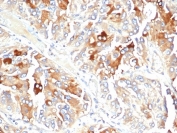 APO-J Antibody Adrenal Gland IHC. Immunohistochemistry analysis of FFPE human adrenal gland tissue using APO-J antibody. The mouse monoclonal antibody clone CLU/4723 demonstrates cytoplasmic staining in glandular cells, consistent with Clusterin / APO-J expression as a lipid transport and chaperone protein. Signal is observed within adrenal cortical cell populations, reflecting the presence of this secreted glycoprotein in metabolically active and lipid-associated tissue environments, while surrounding stromal elements show lower staining. HIER: boil tissue sections in 10 mM Tris with 1 mM EDTA, pH 9, for 20 min followed by cooling prior to staining.