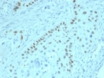 p63 Antibody Human Prostate Tissue. Immunohistochemistry analysis of Tumor protein 63 (TP63) in FFPE human prostate tissue using a p63 antibody as a prostate epithelial integrity marker (clone PCRP-TP63-2G3) demonstrates strong HRP-DAB brown nuclear staining in basal epithelial cells forming a continuous layer along glandular structures. Luminal epithelial cells remain negative, creating a clear contrast that reflects intact epithelial organization. The uniform basal nuclear staining highlights preserved glandular architecture and supports assessment of epithelial integrity within the tissue. The nuclear-restricted signal with low background enables confident identification of TP63-positive basal cells and clear delineation of epithelial compartments. Heat-induced epitope retrieval was performed by boiling tissue sections in pH 9 10mM Tris with 1mM EDTA for 20 minutes followed by cooling prior to antibody incubation.