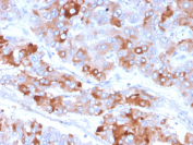 APO-J Antibody Adrenal Gland Tissue IHC. Immunohistochemistry analysis of FFPE human adrenal gland tissue using APO-J antibody. The monoclonal antibody clone CLU/4733 demonstrates cytoplasmic staining in adrenal cortical cells, consistent with Clusterin / APO-J expression as a lipid transport and chaperone protein. Signal is distributed throughout glandular cell populations with areas of extracellular deposition, reflecting secretion and accumulation of this glycoprotein within the tissue microenvironment. HIER: Tris/EDTA buffer, pH 9.0, for 45 min followed by HRP-polymer detection and DAB chromogen development.