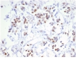 ESR1 Antibody Breast Cancer IHC. Immunohistochemistry staining of FFPE human breast carcinoma tissue with recombinant ESR1 antibody (clone ESR1/6983R). HIER: boil tissue sections in pH 9 10mM Tris with 1mM EDTA for 20 min and allow to cool before testing.