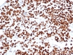 TP53 Antibody / Tumor Suppressor Protein Antibody immunohistochemistry of human serous ovarian carcinoma. Formalin-fixed, paraffin-embedded human serous ovarian carcinoma tissue was stained using recombinant mouse monoclonal antibody clone rTP53/6927. Strong HRP-DAB brown nuclear staining is observed in tumor epithelial cells, consistent with nuclear localization of the TP53 tumor suppressor protein p53. Hematoxylin counterstain provides nuclear contrast. Antigen retrieval was performed by boiling tissue sections in pH 9 10mM Tris with 1mM EDTA for 20 min followed by cooling prior to staining.