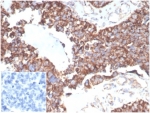 TREM2 Antibody Human Ovarian Cancer Tissue IHC. Immunohistochemistry staining of FFPE human ovarian carcinoma tissue with TREM2 antibody (clone TREM2/7210). Negative control inset: PBS instead of primary antibody to control for secondary binding. HIER: boil tissue sections in pH 9 10mM Tris with 1mM EDTA for 20 min and allow to cool before testing.
