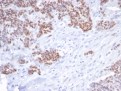 TP53 Antibody / DNA Damage Response Protein Antibody immunohistochemistry of human serous ovarian carcinoma. Formalin-fixed, paraffin-embedded human serous ovarian carcinoma tissue was stained using recombinant mouse monoclonal antibody clone rTP53/6940. Strong HRP-DAB brown nuclear staining is observed in tumor epithelial cells, consistent with nuclear localization of the TP53 DNA damage response protein p53. Hematoxylin counterstain provides nuclear contrast. Antigen retrieval was performed by boiling tissue sections in pH 9 10mM Tris with 1mM EDTA for 20 min followed by cooling prior to staining.