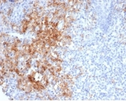 CD38 Antibody Tonsil IHC. Immunohistochemistry analysis of CD38 expression in FFPE human tonsil tissue using CD38 antibody clone CD38/7017R. Strong membranous and cytoplasmic HRP-DAB brown staining highlights plasma cells and activated lymphocytes within interfollicular regions, with dense clusters of positive immune cells surrounding germinal centers. The staining pattern supports identification of lymphoid cell populations consistent with a hematologic malignancy marker context, with clear contrast against predominantly negative background lymphocytes. HIER was performed by boiling tissue sections in pH 9 10 mM Tris with 1 mM EDTA for 20 minutes followed by cooling prior to antibody incubation.