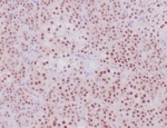 SF-1 Antibody Adrenal Cortical Tumor IHC. Immunohistochemistry analysis of FFPE human adrenal cortical tumor tissue stained with recombinant SF-1 Antibody demonstrates strong diffuse nuclear HRP-DAB brown staining throughout neoplastic cellular populations, consistent with expression of steroidogenic factor 1 / NR5A1 in adrenal steroidogenic lineage-associated tumor cells. This steroidogenic factor 1 western blot antibody highlights nuclear localization patterns associated with endocrine differentiation, adrenal cortical identity, and steroid hormone-associated transcriptional regulation pathways. HIER: boil tissue sections in pH 9 10mM Tris with 1mM EDTA for 20 min and allow to cool before testing.