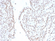 SF-1 Antibody Renal Oncocytoma IHC. Immunohistochemistry analysis of FFPE human renal oncocytoma tissue stained with recombinant SF-1 Antibody demonstrates widespread nuclear HRP-DAB brown staining within oncocytic epithelial tumor cell populations, consistent with expression of steroidogenic factor 1 / NR5A1 in transcriptionally active neoplastic cellular compartments. This steroidogenic factor 1 western blot antibody highlights nuclear localization patterns associated with endocrine-associated transcriptional regulation and steroidogenic lineage-related signaling pathways. HIER: boil tissue sections in pH 9 10mM Tris with 1mM EDTA for 20 min and allow to cool before testing.