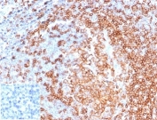 CD22 Antibody Tonsil IHC. Immunohistochemistry analysis of CD22/Siglec-2 expression in FFPE human tonsil tissue using CD22 Antibody / B Cell Activation Modulation Antibody clone rBLCAM/6749 at 2 ug/ml. Prominent HRP-DAB brown staining is detected in follicular B lymphocytes with strong membranous and cytoplasmic localization, emphasizing dense B cell populations within germinal centers, while surrounding non-lymphoid tissue shows minimal background. The staining distribution is consistent with CD22 function in regulating B cell activation and supports use of this CD22 antibody for immunohistochemistry-based assessment of immune response dynamics in lymphoid tissues. Inset: PBS was used in place of the primary antibody as a negative control to demonstrate specificity of staining. Heat-induced epitope retrieval was performed in pH 9 Tris-EDTA buffer for 20 minutes followed by cooling prior to antibody incubation.