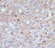 SERPINA3 Antibody Liver Immunohistochemistry. IHC staining of FFPE human liver tissue with SERPINA3 antibody (clone SERPINA3/4190). HIER: boil tissue sections in pH 9 10mM Tris with 1mM EDTA for 20 min and allow to cool before testing.
