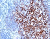 CD23 Antibody Tonsillar Germinal Center IHC. Immunohistochemistry of CD23 Antibody in human tonsil. FFPE human tonsil tissue was stained with CD23 antibody mouse monoclonal clone FCER2/4918 at 2 ug/ml in PBS for 30 minutes at room temperature. Strong membranous HRP-DAB brown staining is observed in B lymphocytes within germinal centers and mantle zone regions, consistent with established CD23 expression on mature follicular B cells. The staining pattern clearly delineates follicular architecture, with dense membrane labeling in B cell rich areas and minimal staining in adjacent T cell predominant interfollicular zones. The negative control inset shows tissue processed with PBS in place of primary antibody, demonstrating absence of non-specific secondary antibody binding. Heat induced epitope retrieval was performed by boiling tissue sections in pH 9 Tris-EDTA buffer for 20 minutes followed by cooling prior to antibody incubation.