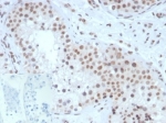 SF-1 Antibody Testis IHC. Immunohistochemistry analysis of FFPE human testis tissue stained with SF-1 Antibody demonstrates strong nuclear HRP-DAB brown staining within seminiferous tubule-associated cellular populations, consistent with expression of steroidogenic factor 1 / NR5A1 in gonadal and endocrine-associated transcriptionally active compartments. This steroidogenic factor 1 antibody highlights nuclear localization patterns associated with reproductive tissue differentiation, steroidogenic signaling, and endocrine lineage-associated transcriptional regulation pathways. Inset: PBS was used in place of primary antibody as a negative control to assess non-specific secondary antibody binding. Antibody concentration: 2ug/ml. HIER: boil tissue sections in pH 9 10mM Tris with 1mM EDTA for 20 min and allow to cool before testing.