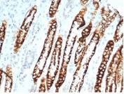 CDH16 Antibody Human Renal Cell Carcinoma Tissue IHC. Immunohistochemistry staining of FFPE human renal cell carcinoma tissue with recombinant CDH16 antibody (clone CHD16/7027R) at 2ug/ml in PBS for 30min RT. HIER: boil tissue sections in pH 9 10mM Tris with 1mM EDTA for 20 min and allow to cool before testing.