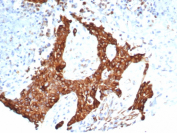 Tubulin Beta Antibody Tumor IHC. Immunohistochemical analysis of Tubulin beta 3 (TUBB3) in formalin-fixed, paraffin-embedded human ovarian carcinoma tissue using Tubulin Beta antibody clone TUBB3/7090R. Cytoplasmic staining is observed in tumor cells, consistent with localization of TUBB3 within the microtubule network.