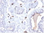 Fatty Acid Binding Protein 4 Antibody Breast Carcinoma IHC. Immunohistochemistry staining of FFPE human breast carcinoma tissue with Fatty Acid Binding Protein 4 antibody (clone FABP4/4422). HIER: boil tissue sections in pH 9 10mM Tris with 1mM EDTA for 20 min and allow to cool before testing.