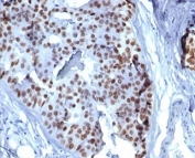 GATA Binding Protein 3 Antibody Lobular Breast Carcinoma IHC. Immunohistochemistry analysis of FFPE human lobular breast carcinoma tissue stained with GATA Binding Protein 3 Antibody clone GATA3/6664 demonstrates strong diffuse nuclear HRP-DAB brown staining throughout malignant epithelial cell populations, consistent with the established role of GATA binding protein 3 / GATA3 in luminal epithelial differentiation and breast lineage-associated transcriptional regulation. The prominent nuclear staining pattern supports the utility of GATA3 as a marker of mammary epithelial identity in breast carcinoma research and pathology-associated studies. HIER: boil tissue sections in pH 9 10mM Tris with 1mM EDTA for 20 min and allow to cool before testing.