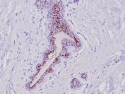 GATA Binding Protein 3 Antibody Lobular Breast Carcinoma IHC. Immunohistochemistry analysis of FFPE human lobular breast carcinoma tissue stained with GATA Binding Protein 3 Antibody clone GATA3/6664 demonstrates strong nuclear HRP-DAB brown staining within malignant epithelial cell populations arranged in infiltrative glandular and cord-like structures, consistent with the established role of GATA binding protein 3 / GATA3 in luminal epithelial differentiation and mammary lineage-associated transcriptional regulation. The distinct nuclear localization pattern supports the use of GATA3 as a breast epithelial marker in carcinoma-associated tissue studies. HIER: boil tissue sections in pH 9 10mM Tris with 1mM EDTA for 20 min and allow to cool before testing.
