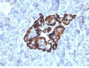 VDBP Antibody Renal Oncocytoma IHC. Immunohistochemistry analysis of FFPE human renal oncocytoma tissue stained with VDBP Antibody clone VDBP/4481 demonstrates strong granular cytoplasmic HRP-DAB brown staining within tumor-associated epithelial cell populations, consistent with the role of Vitamin D binding protein / VDBP in endocrine transport physiology and metabolic carrier-associated signaling pathways. The observed staining profile aligns with the secretory and transport-associated biology of this circulating vitamin D metabolite carrier protein. Tissue sections were stained using 2 ug/ml antibody in PBS for 30 min at room temperature. HIER: boil tissue sections in pH 9 10mM Tris with 1mM EDTA for 20 min and allow to cool before testing.