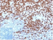 CD5 Antibody for IHC. Immunohistochemistry analysis of CD5 antibody staining in FFPE human tonsil tissue using a tumor immune microenvironment marker antibody, clone C5/4516R. Strong membranous staining is observed in interfollicular T lymphocytes with dense labeling of T cell zones surrounding germinal centers, while follicular B cell areas remain largely negative. The staining highlights immune cell distribution within lymphoid compartments and reflects the role of CD5 in identifying T cell populations relevant to immune infiltration. Negative control inset shows PBS used in place of primary antibody with no specific staining, confirming secondary antibody specificity. Heat-induced epitope retrieval was performed using pH 9 Tris-EDTA buffer for 20 minutes followed by cooling prior to antibody incubation.