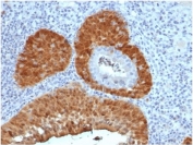 CDKN2A Antibody Human Cervix Tissue IHC. staining of FFPE human cervix with CDKN2A antibody (clone rCDKN2A/4845). HIER: boil tissue sections in pH 9 10mM Tris with 1mM EDTA for 20 min and allow to cool before testing.