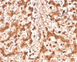 Cathepsin D Antibody Liver Tissue IHC. Immunohistochemistry analysis of FFPE human liver tissue using CTSD antibody (clone CTSD/4497) shows diffuse granular cytoplasmic staining in hepatocytes, consistent with CTSD / Cathepsin D localization in lysosomal compartments. The punctate staining pattern reflects lysosomal protease distribution associated with intracellular protein processing and turnover. Hepatic architecture is preserved, and surrounding non-parenchymal regions display comparatively lower staining. Hematoxylin counterstain provides nuclear contrast and structural context. HIER: boil FFPE tissue sections in pH 9 10 mM Tris with 1 mM EDTA for 20 min and allow to cool before testing.