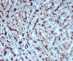 Cathepsin D Antibody Liver Metastasis in Colon IHC. Immunohistochemistry analysis of FFPE human liver carcinoma metastatic to colon tissue using CTSD antibody (clone CTSD/4497) shows strong granular cytoplasmic staining in tumor cells, consistent with CTSD / Cathepsin D localization in lysosomal compartments. The punctate staining pattern reflects elevated lysosomal protease activity associated with tumor progression and metastatic behavior. Tumor cell clusters are well defined, while surrounding stromal and non-tumor regions display comparatively lower staining. Hematoxylin counterstain provides nuclear contrast and structural context. HIER: boil FFPE tissue sections in pH 9 10 mM Tris with 1 mM EDTA for 20 min and allow to cool before testing.
