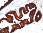 Recombinant PSA Antibody KLK3/4602R IHC staining of human prostate carcinoma. Immunohistochemistry analysis of FFPE human prostate carcinoma tissue using Recombinant PSA Antibody KLK3/4602R shows strong HRP-DAB brown cytoplasmic staining in malignant glandular epithelial cells forming tumor glands, consistent with Prostate specific antigen (KLK3) expression in prostate-derived carcinoma cells, while surrounding stromal cells are largely negative. HIER: tissue sections were boiled in pH 9 10mM Tris with 1mM EDTA for 20 minutes and allowed to cool before testing.